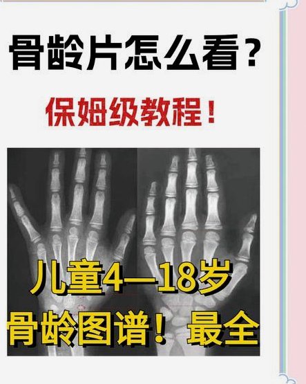 董路态度转变，一开始支持测骨龄，现在否认骨龄科学性